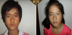 杨小朋友 10岁 左脸及鼻端部位白斑1年多