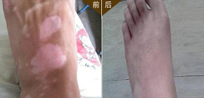 吴先生 29岁 脚部白斑6个月