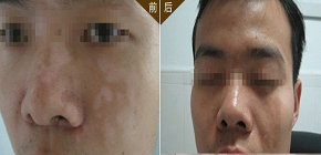 罗先生 34岁 眉端、鼻梁、左脸部白斑1年